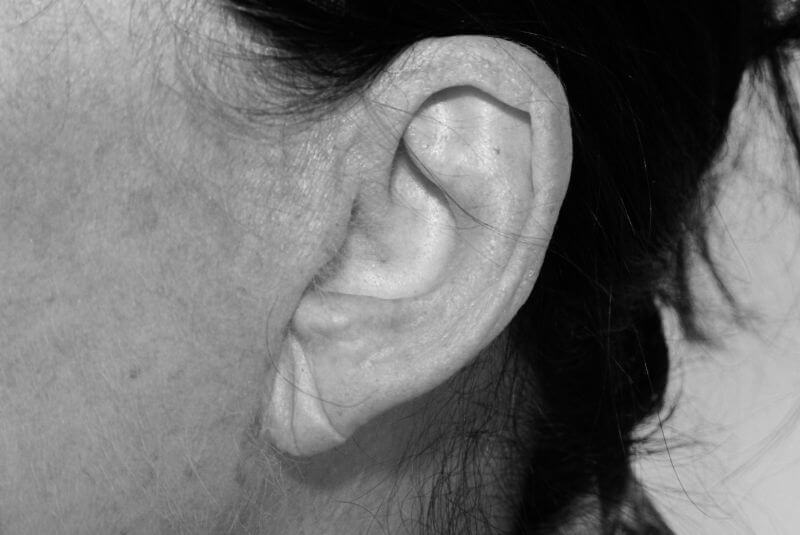 Behandlung von Falten am Ohrläppchen, Region Stuttgart