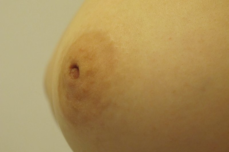 eingezogene Brustwarze, Schlupfwarze, Hohlwarze, Raum Stuttgart